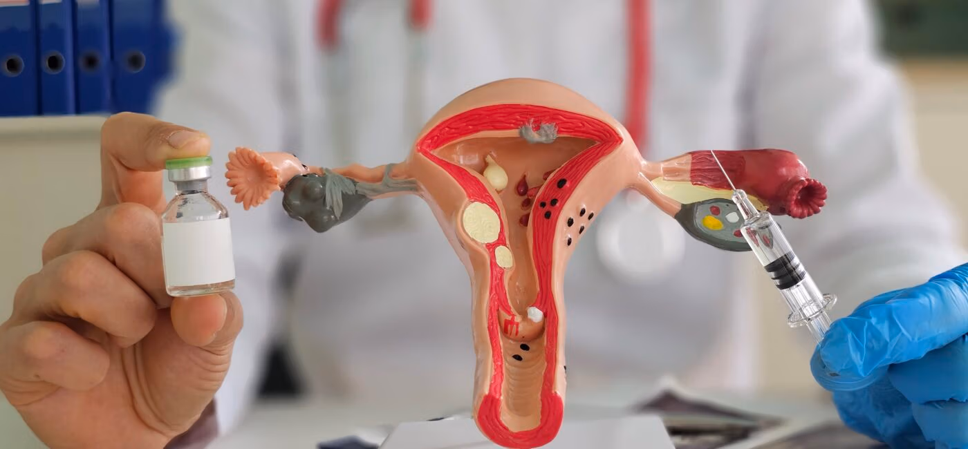 Lupron Before Fibroid Surgery: Clearing Up a Common Misconception