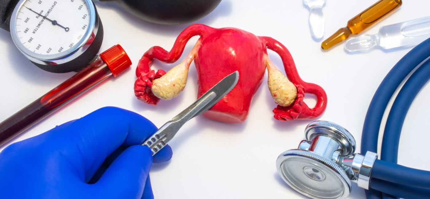 Part 2: Bowel Endometriosis – Treatment, Surgery, and Fertility